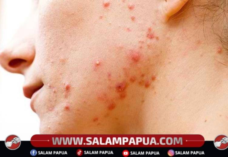 Kenali Berbagai Cara Menghilangkan Jerawat Pasir