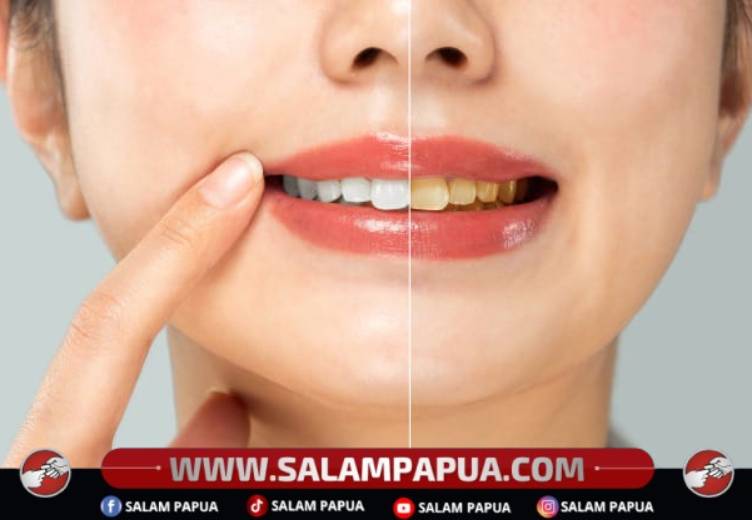 Rambu-Rambu Pemutihan Gigi