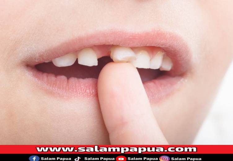 Gigi Goyang, Ketahui Penyebab Dan Cara Mengatasinya