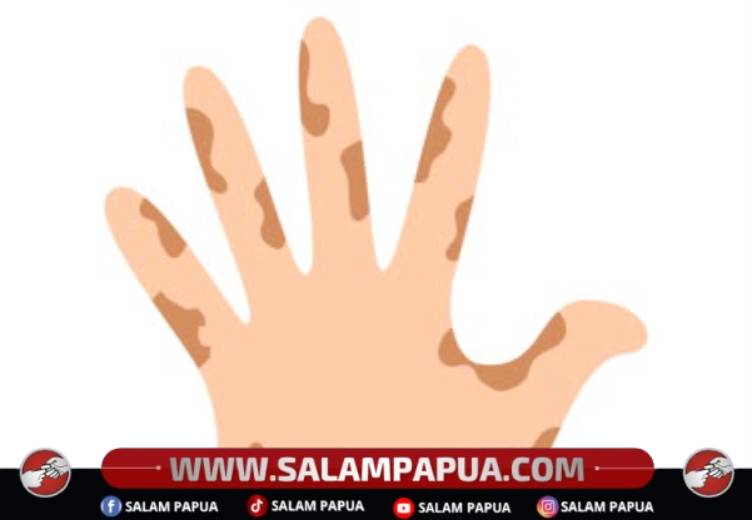 Tahun 2025 Dinkes Mimika Rampungkan Pengobatan 8 Pasien Kusta, 2026 Masih Penanganan