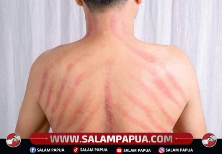 Manfaat Kerokan Dalam Mengatasi Masuk Angin