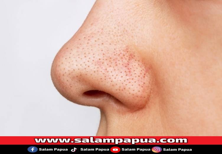 7 Cara Menghilangkan Komedo Di Hidung Dengan Cepat